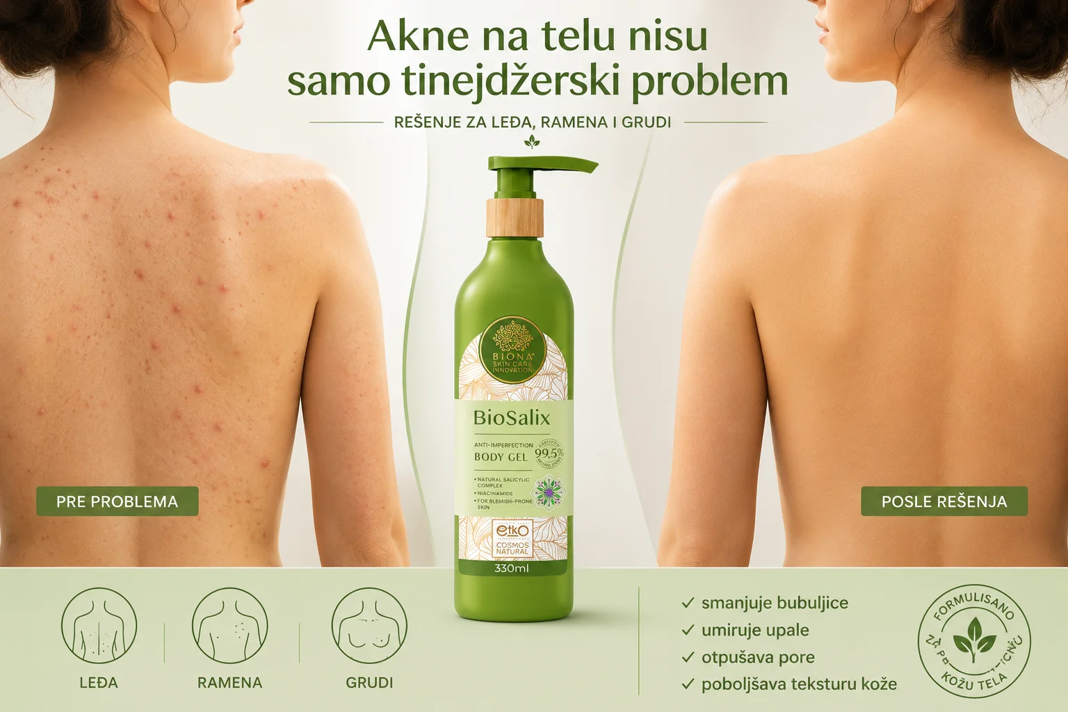 Akne na leđima